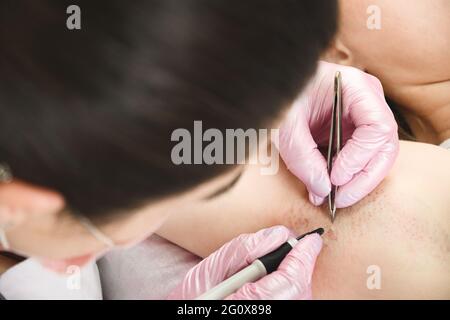 Procédure d'épilation électrique des poils en permanence dans les aisselles d'une femme. Traitement de l'enlèvement des cheveux de façon permanente à l'aide de l'électrolyse. Voir fr Banque D'Images