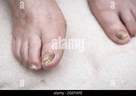 Infection de champignon sur les ongles du pied de l'homme.fond blanc, tir à l'intérieur. Banque D'Images