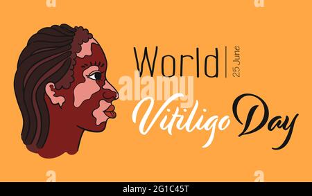 Journée mondiale de Vitiligo. Dreadlocks fille de cheveux avec taches de pigment de vitiligo. Portrait de la femme en vue latérale - vecteur isolé Illustration de Vecteur