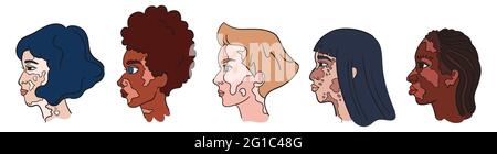 Journée mondiale de Vitiligo. Les femmes sont confrontées à des taches de pigment. Portraits isolés - ensemble de vitiligo vectoriel Illustration de Vecteur