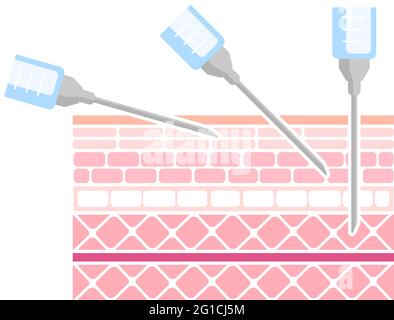 Illustration de vecteur angles pour l'insertion d'injections Illustration de Vecteur