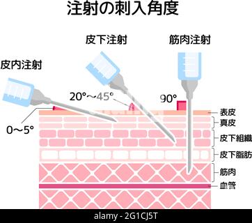 Illustration de vecteur angles pour l'insertion d'injections Illustration de Vecteur