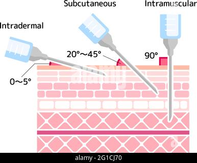 Illustration de vecteur angles pour l'insertion d'injections Illustration de Vecteur