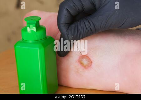 Eczéma dyshidrotique sur le pied, dermatite. Une main gantée tient une aiguille pour percer la plaquette thermoformée. À côté est un pot d'antiseptique. Gros plan. Banque D'Images