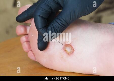 Eczéma dyshidrotique sur le pied. Dermatite de plaquette. Une main gantée tient un dispositif autopiqueur. Gros plan. Banque D'Images