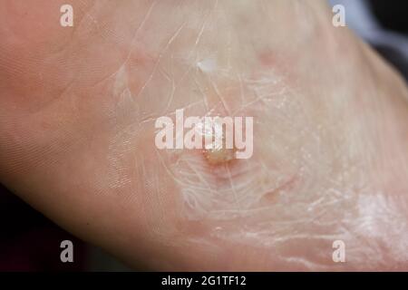 Eczéma dyshidrotique sur le pied. Dermatite de plaquette. Traité avec de l'onguent. Gros plan. Banque D'Images