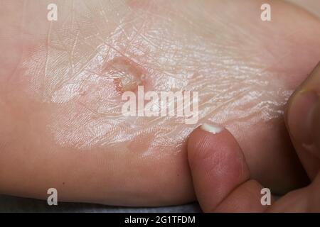 Eczéma dyshidrotique sur le pied. Dermatite de plaquette. Il est traité avec de la pommade. Gros plan. Banque D'Images