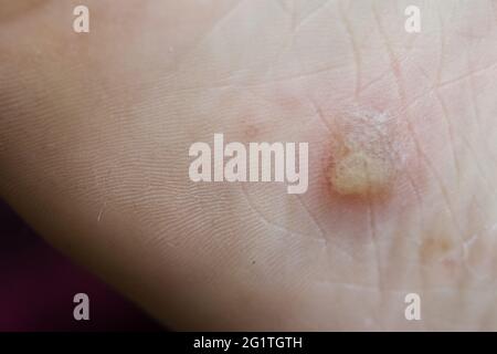 Eczéma dyshidrotique sur le pied. Dermatite de plaquette. Gros plan. Banque D'Images