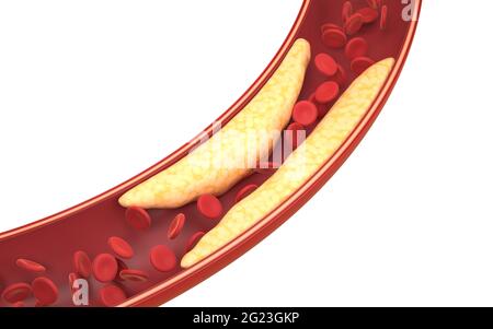 Globules rouges et gras dans les vaisseaux sanguins, rendu 3d. Dessin numérique informatique. Banque D'Images