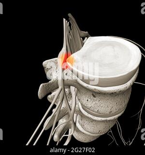 Un disque hernié appuyant sur un nerf spinal, sur fond noir. Banque D'Images