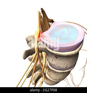 Un disque hernié appuyant sur un nerf spinal, sur fond blanc. Banque D'Images