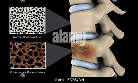 Ostéoporose sur la colonne vertébrale, avec des sections agrandies qui la comparent à la structure osseuse normale. Banque D'Images