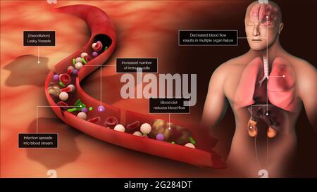 Illustration biomédicale de la septicémie dans la circulation sanguine, déclenchant des réponses inflammatoires dans tout le corps. Banque D'Images