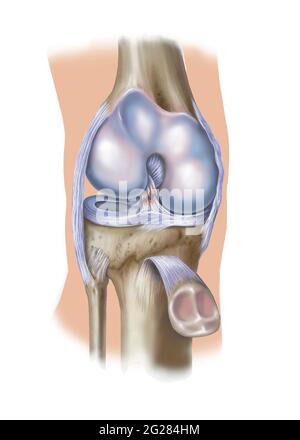 Vue avant du genou montrant une déchirure antérieure du ligament croisé. Banque D'Images