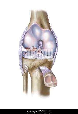 Vue avant du genou montrant une ACL et un ménisque déchirés. Banque D'Images