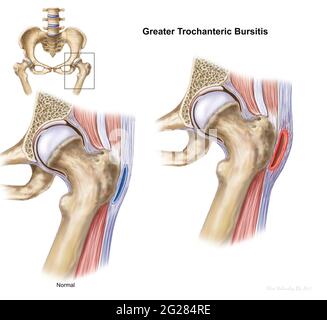 Détails montrant une plus grande bursite trochanter dans l'articulation de la hanche. Banque D'Images