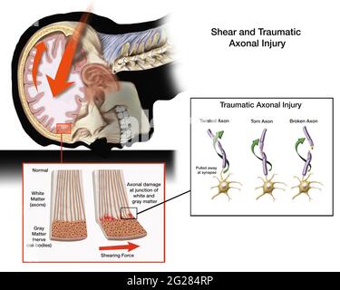 Cerveau ayant un impact sur le crâne. Détail du cisaillement et du traumatisme axonal. Banque D'Images