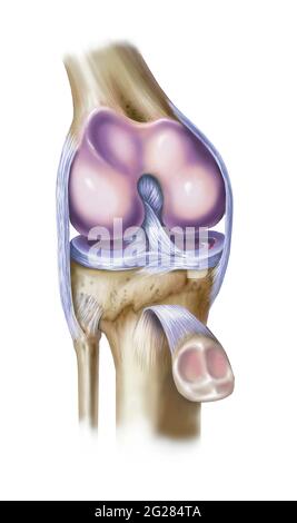 Vue avant du genou montrant un ménisque médial déchiré. Banque D'Images