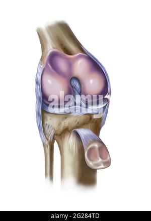 Vue avant du genou montrant un ligament collatéral médian déchiré. Banque D'Images