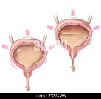 Comparaison d'une vessie pleine et d'une vessie hyperactive envoyant des signaux au cerveau quand se vider. Banque D'Images