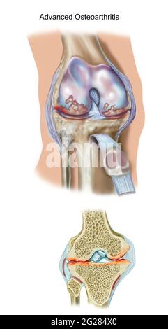 Vue avant et coupe transversale du genou montrant une arthrose avancée. Banque D'Images