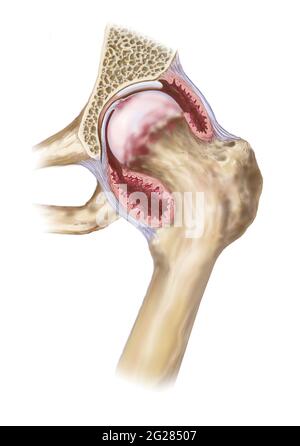 Polyarthrite rhumatoïde dans l'articulation de la hanche, montrant une inflammation de la capsule et des tissus. Banque D'Images