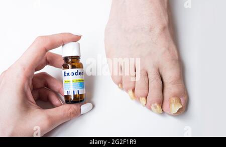 Avril 2021, Bucarest, Roumanie. La femme applique Exoderil, traitement de champignon de Nail aux ongles longs infectés de l'homme Banque D'Images