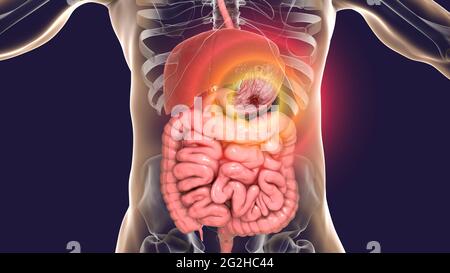 Ulcère gastrique, illustration Banque D'Images