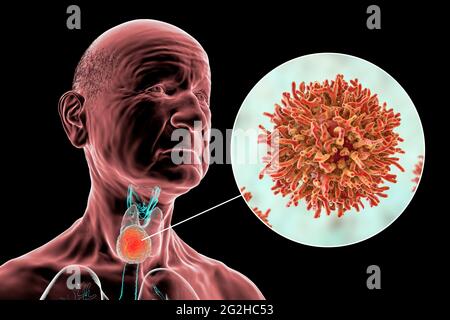 Cancer de la glande thyroïde, illustration Banque D'Images