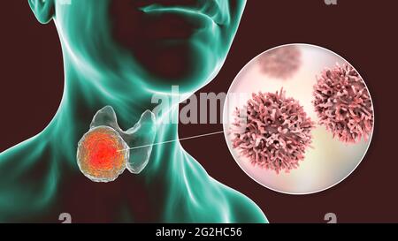 Cancer de la glande thyroïde, illustration Banque D'Images