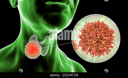 Cancer de la glande thyroïde, illustration Banque D'Images