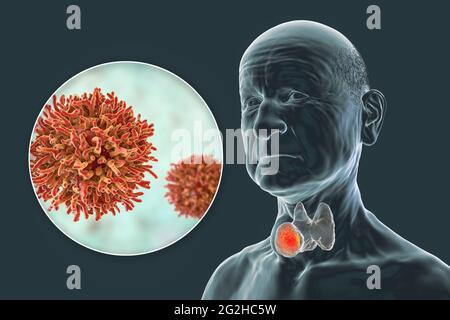 Cancer de la glande thyroïde, illustration Banque D'Images