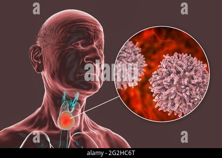 Cancer de la glande thyroïde, illustration Banque D'Images