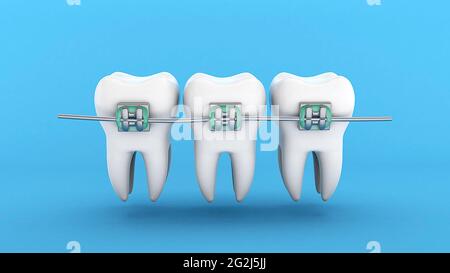 Bretelles de dents. Alignement des dents. Trois dents blanches avec bretelles sur fond bleu. rendu 3d. Banque D'Images