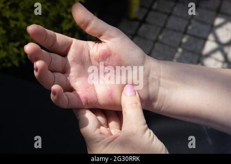 Eczéma allergique sévère sur les mains. Peau rouge fissurée avec des cloques. La femme se grattait la main Banque D'Images