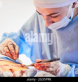 Gros plan de la jeune femme chirurgien plaçant des sutures après la chirurgie de tummy tummy. Femme médecin effectuant une chirurgie abdominale en plastique dans la salle d'opération. Concept de l'abdominoplastie et de la chirurgie esthétique. Banque D'Images