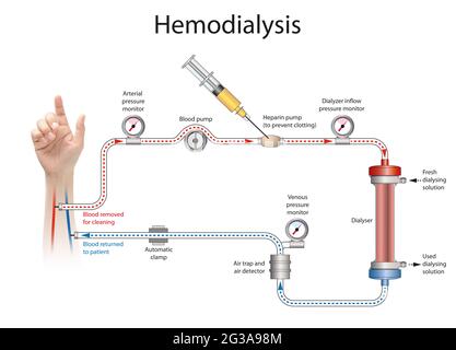 L'hémodialyse ou simplement la dialyse, est un processus de purification du sang d'une personne dont les reins ne fonctionnent pas normalement Banque D'Images
