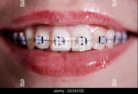 Gros plan horizontal du beau sourire de la femme, montrant des dents blanches saines avec des bretelles en céramique, unis avec du fil rouillé et des bandes en caoutchouc noir. Vue avant Banque D'Images