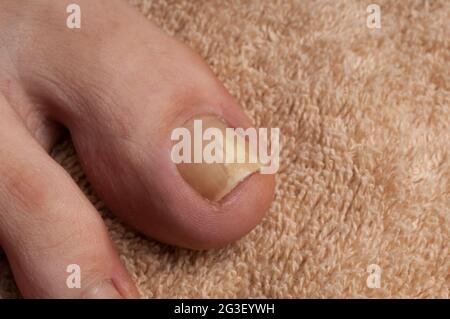 Le champignon de l'ongle du pied (onychomycose) sur le pied d'une femme Banque D'Images