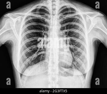 X-Ray Image de la poitrine en bonne santé Banque D'Images