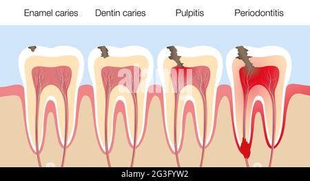 Dents aux stades de carie, développement de la carie dentaire avec l'émail et la dentine carie, pulpite et parodontite. Banque D'Images