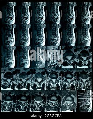 Imagerie par résonance magnétique disques de colonne vertébrale protrusion film de laboratoire Banque D'Images