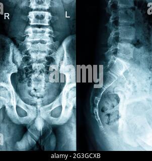 Os pelviens deux positions vérifier le fond noir du roentgenogramme Banque D'Images