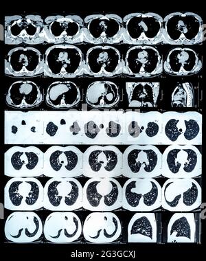 Images tomographiques haute résolution d'un thorax normal dans les plans axial et frontal, respectivement Banque D'Images