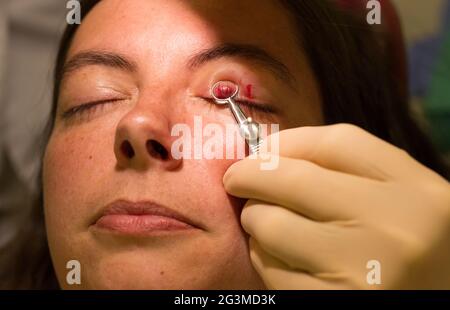 Concept de soins de santé - Chalazion pendant l'examen et l'opération des yeux Banque D'Images