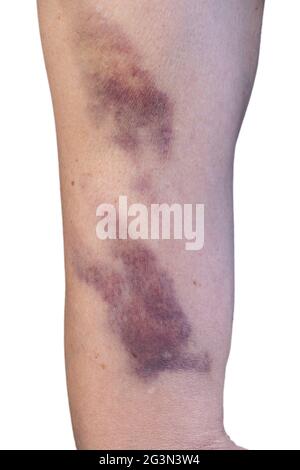 Ecchymose sur la peau du haut du bras d'une femme, causée par une blessure ou une violence domestique. Isolé sur fond blanc. Image verticale Banque D'Images
