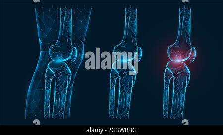 Illustration vectorielle polygonale, vue latérale des articulations de la cuisse et du genou. Maladie, douleur et inflammation de l'articulation du genou. Modèle à faible teneur en polyéthylène Banque D'Images