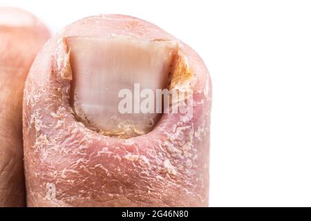 Gros plan d'une infection inflammatoire douloureuse du gros orteil due à l'ongle du pied incarné Banque D'Images