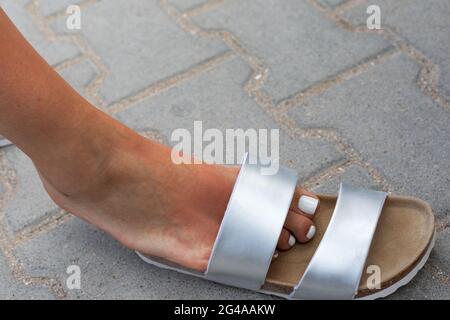 Pied de femme avec ampoules rouges d'allergie au soleil Banque D'Images