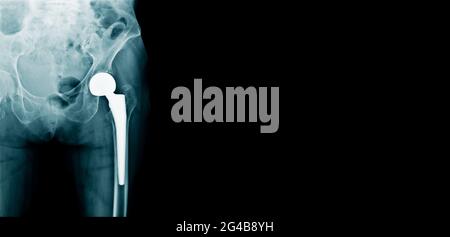image radiographique de remplacement de la hanche sur fond noir, conception de bannière pour espace web et espace de copie pour le texte Banque D'Images